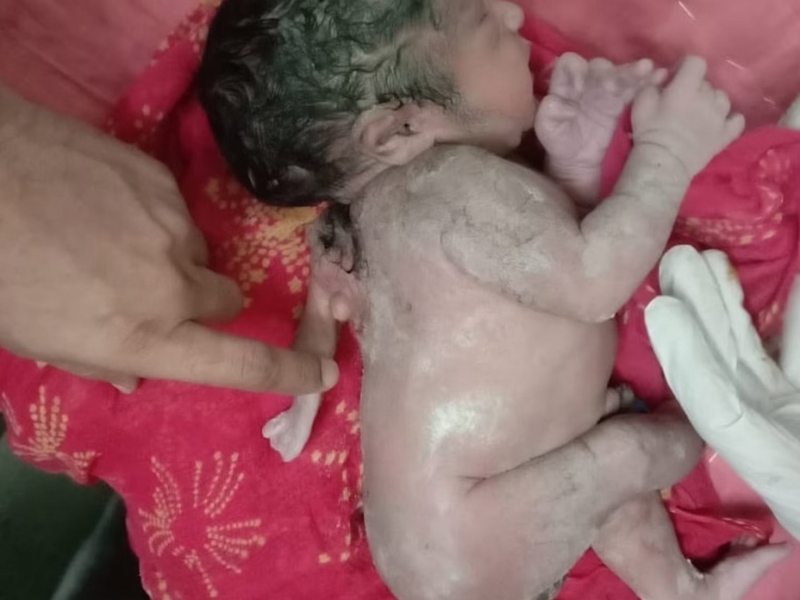 فیلم| تولد نوزادی با سه دست در هند همه را شگفتزده کرد