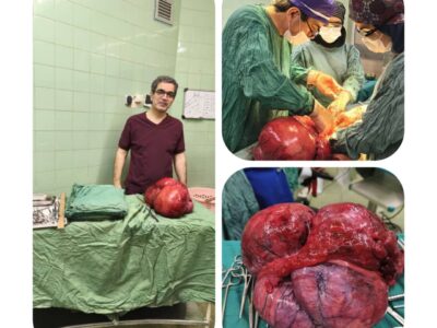 خارج کردن توده سنگین از شکم بیمار پس از سال‌ها درد