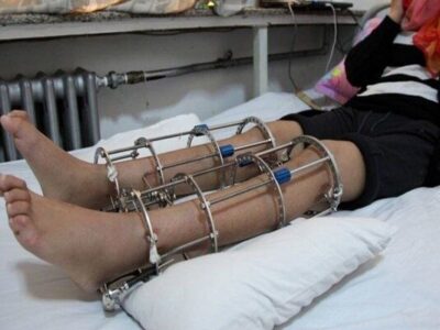 جراحی افزایش قد؛شکنجه مدرن؟