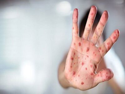 ایران در مرحله حذف سرخک و سرخجه